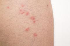 梦见自己身上长了脓包是什么意思